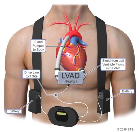 parts of an lvad